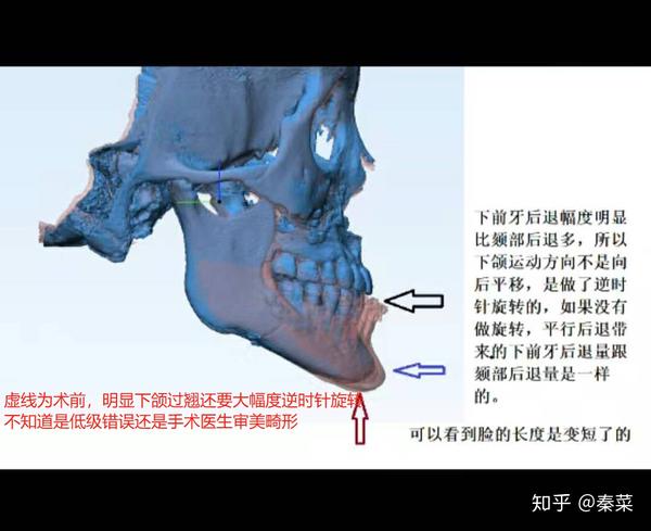 鼻中隔一处穿孔,上颌窦两处穿孔,关节盘移位,还有被后退到只剩五毫米