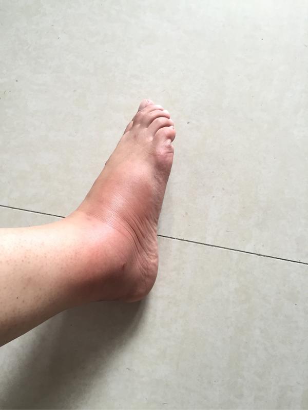 为什么有的人被蚊子咬后是起一个大包,有的人则是出现
