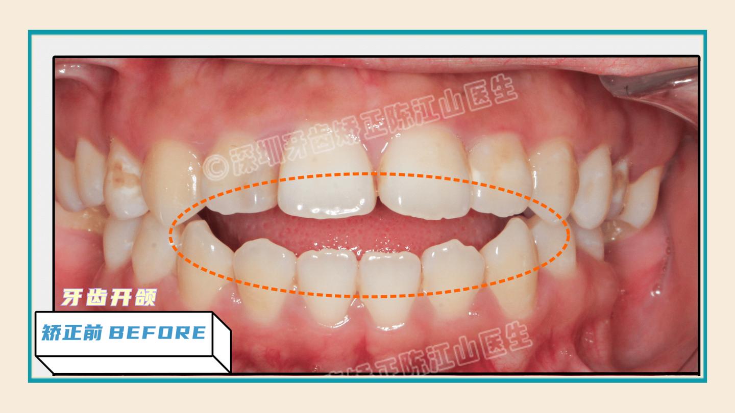 牙齿开颌可以通过正畸改善吗