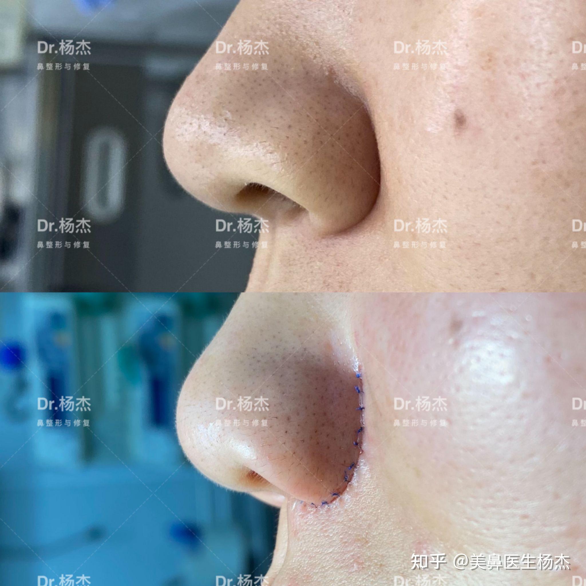 鼻头大鼻翼宽鼻梁高怎么变好看