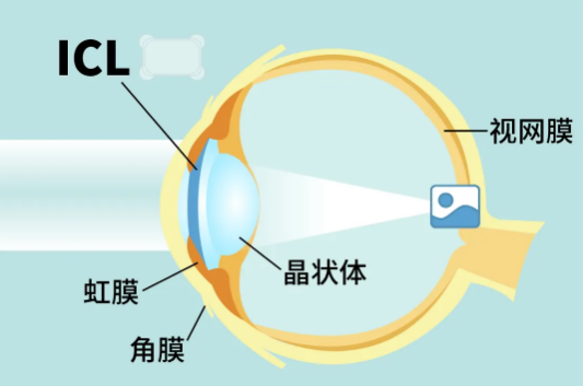 武汉近视手术哪种最好最安全?高度近视才适合做icl手术吗?