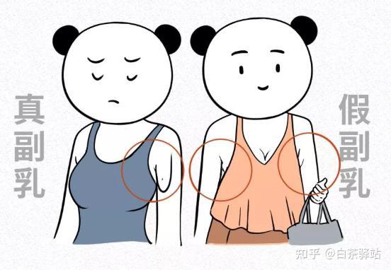 什么是真正的副乳 真正的"副乳"是指人体除了正常的一对乳房之外出现