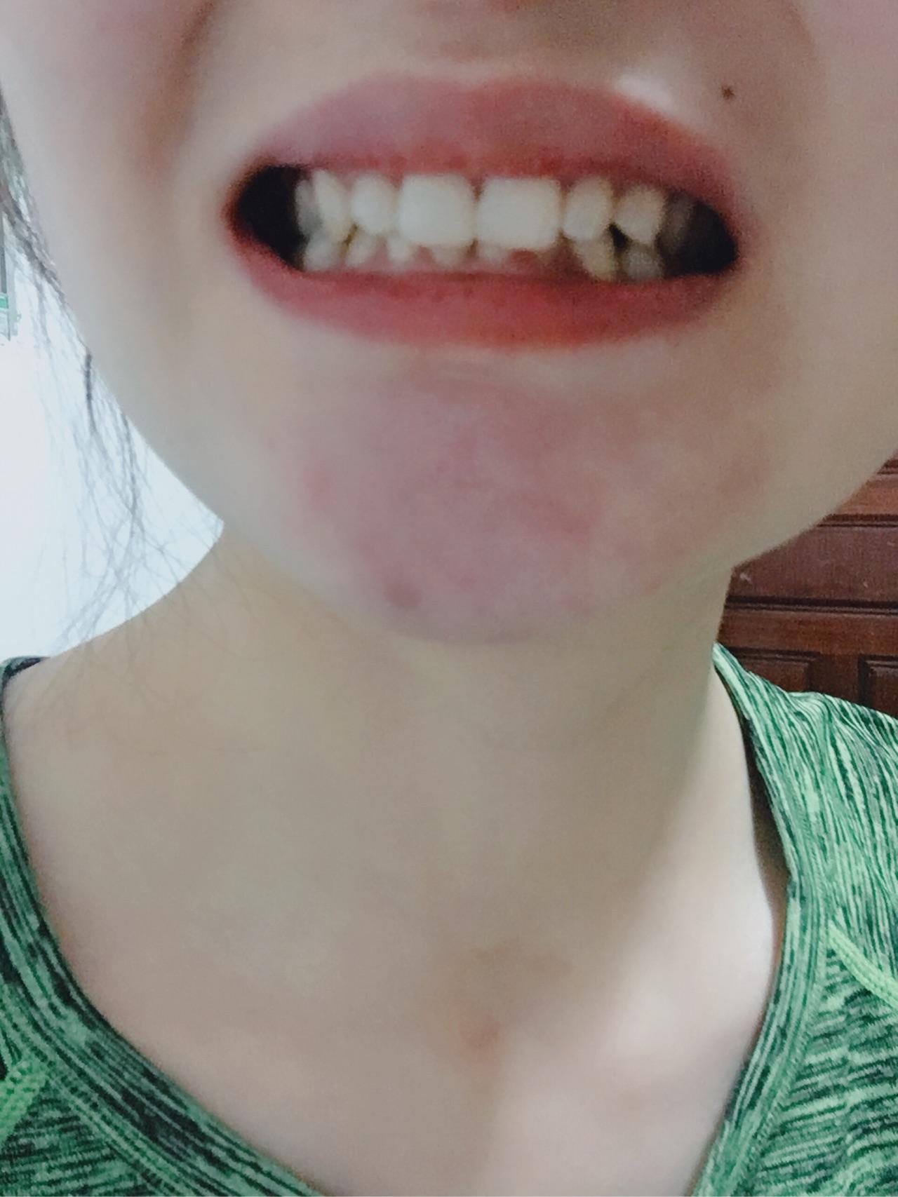 漫漫深覆合牙齿矫正之路记录