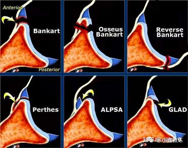 肩关节bankart损伤