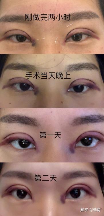 杨幂的狐狸眼vs赵丽颖的杏眼,双眼皮手术四个月后,别人都说我的双眼皮