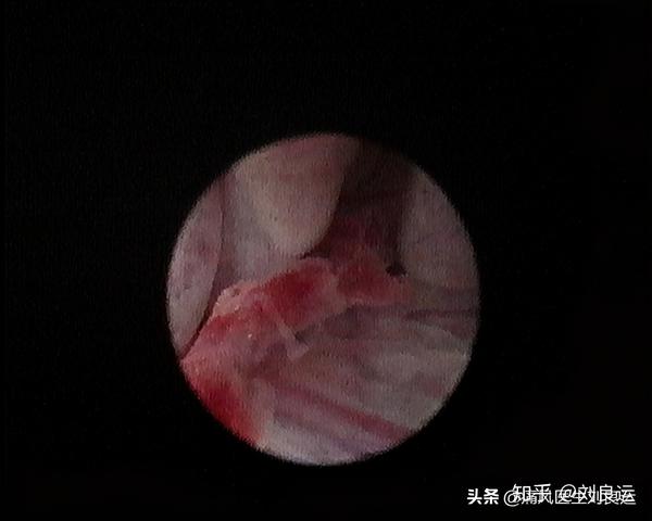 类风湿关节炎针刀镜下血管翳和滑膜增生 总而言之,无论治疗痛风性关节