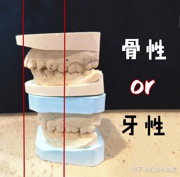 牙性龅牙矫正的过程分享