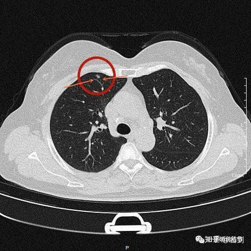 见右上叶前段磨玻璃结节先来看平扫的图像:病人某a,于今年4月份在本院