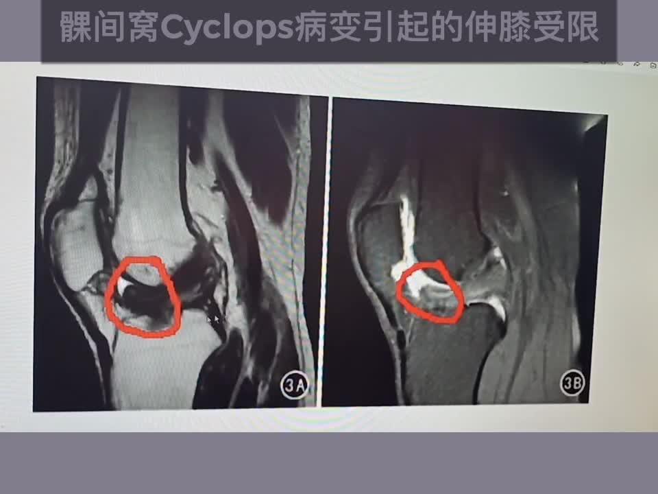 膝关节康复常见误区019——膝关节伸不直如何处理