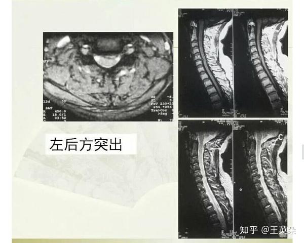 隐形颈椎病,自发椎体融合,颈椎横突肥大,颈肋,齿状突发育不良或缺如等