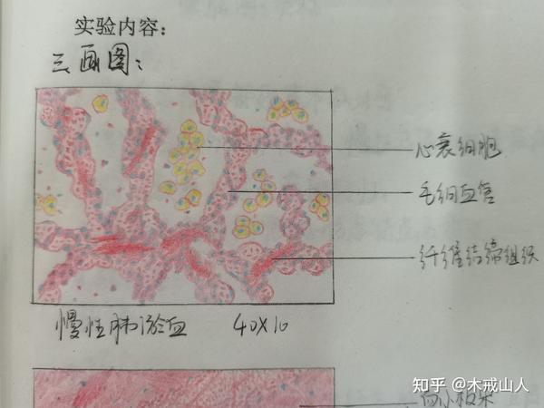 混合血栓 炎细胞 结核结节(部分) 高分化鳞癌 风湿性心肌炎 大叶性