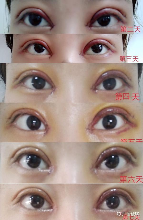 全切开眼角,去皮去脂.