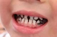 宝宝牙齿颜色黑黑的刷牙刷不掉怎么办?
