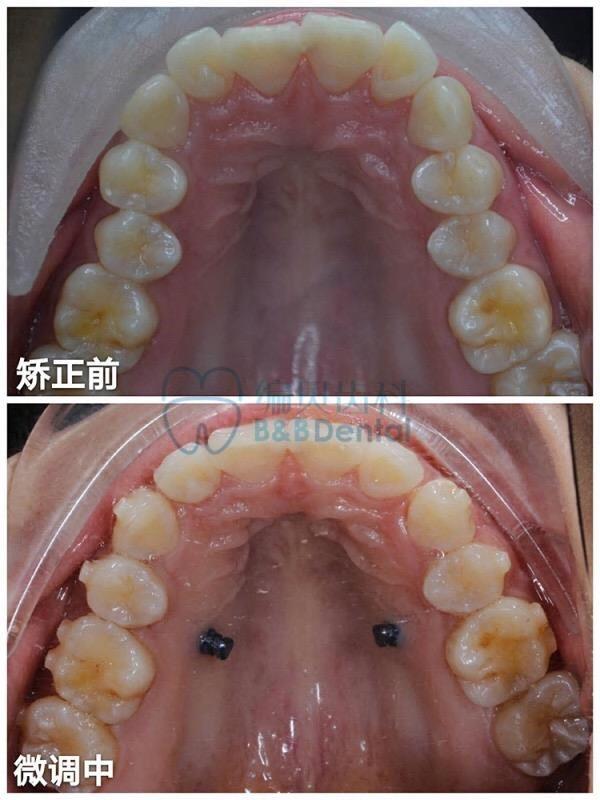 下颌两颗第二前磨牙因为畸形中央尖而选择拔除,通过戴时代天使隐形