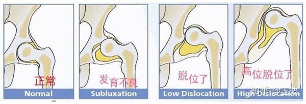 什么是成人髋关节发育不良