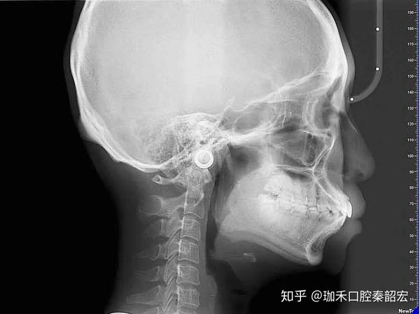 (常见的凸面脸x光片)