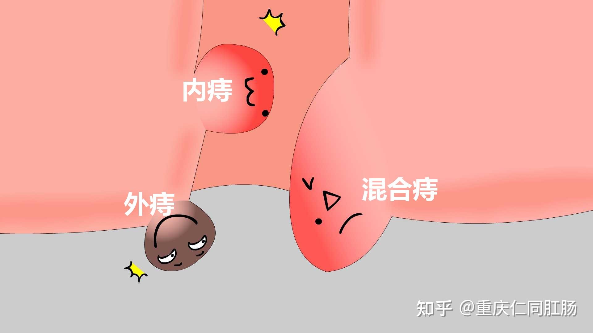 痔疮突然出血如何进行紧急处理重庆肛肠医院告诉大家