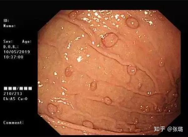 10%～25%为腺瘤性胃息肉, 属于良性肿瘤中的一种