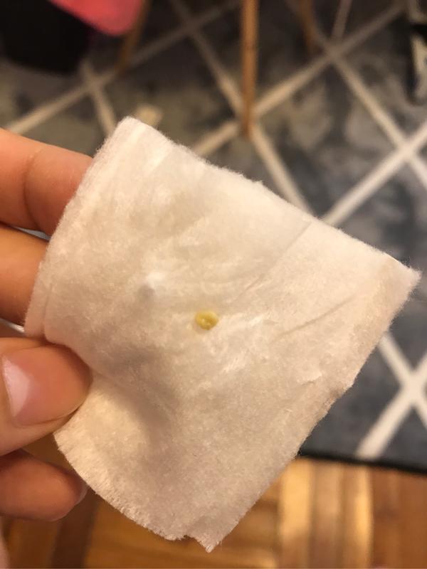 扁桃腺结石怎么清理?