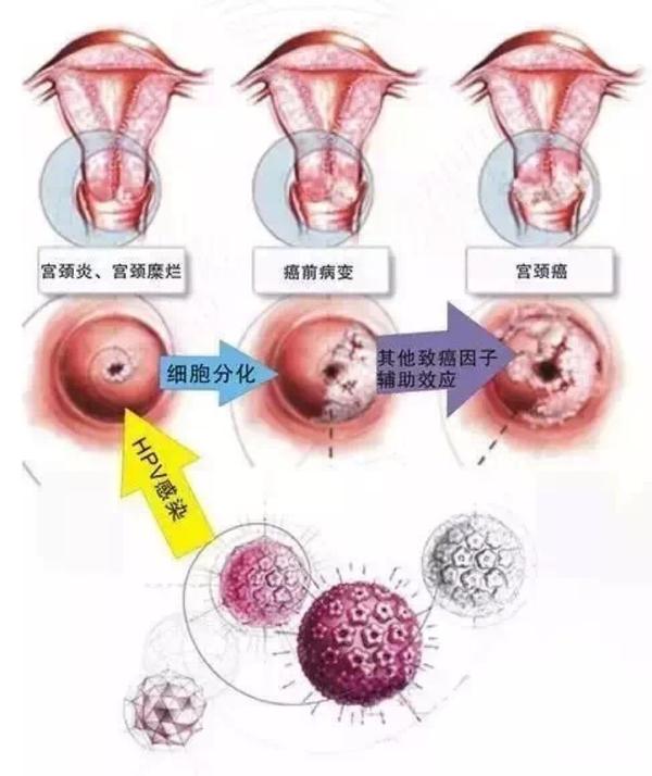 hpv与子宫颈癌
