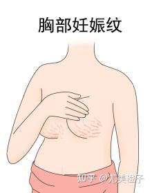 因此,妊娠纹的形成部位,以腹部最多,其它较常见的地方,则有乳房周围