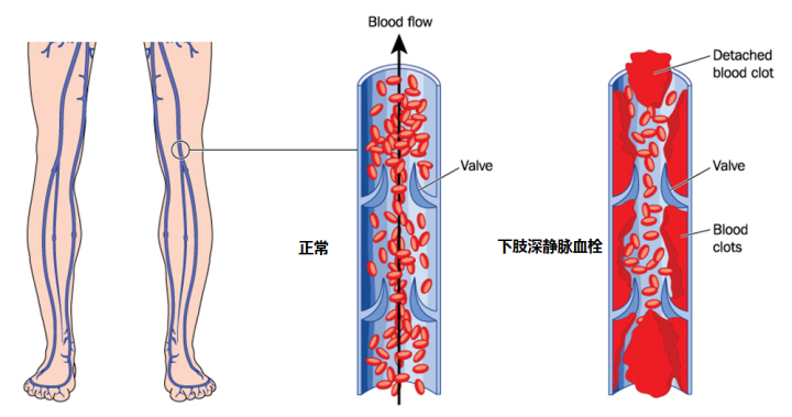 年纪大了腿疼就正常这可能是一种下肢血管病得治