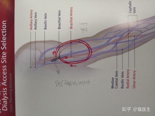 近期静脉压明显升高,彩超检查如下