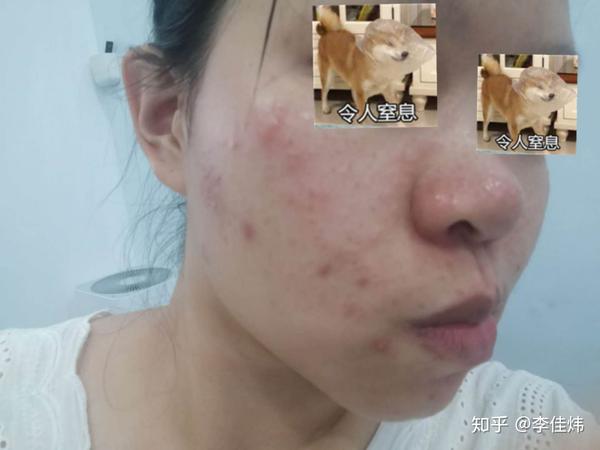 抗战-脸部脂溢性皮炎