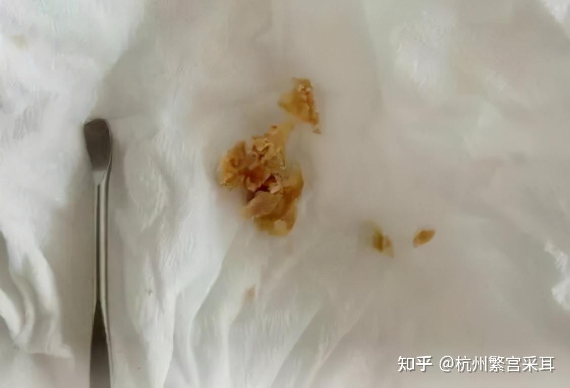 耳朵听力下降有什么东西堵住耳道是不是应该去医院看看