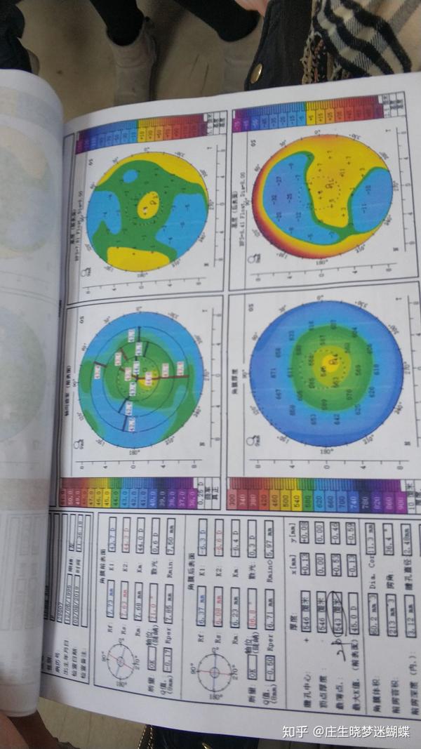 请大神看一下角膜地形图,是不是不规则散光,晚上看东西上下重影?
