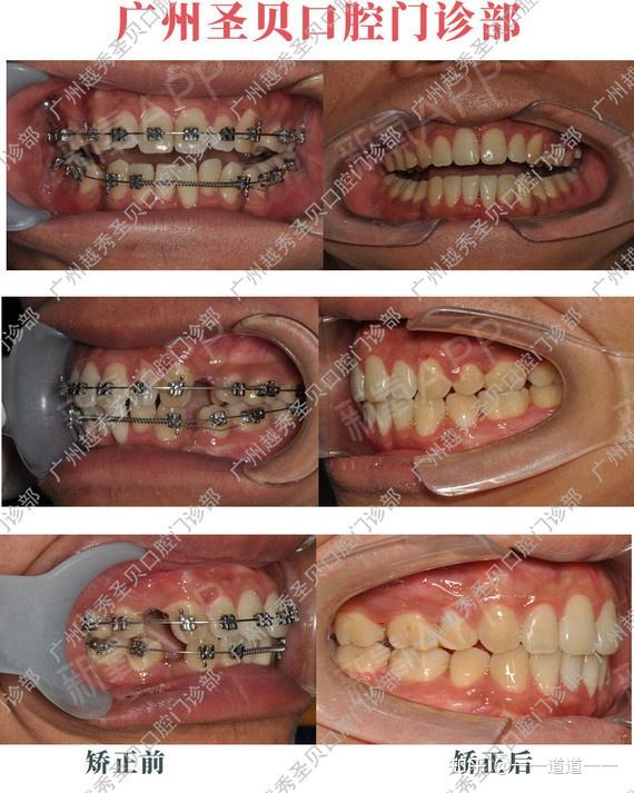 广州圣贝蔡菁菁医生牙齿矫正案例分享:错颌畸形 双颌前突治疗
