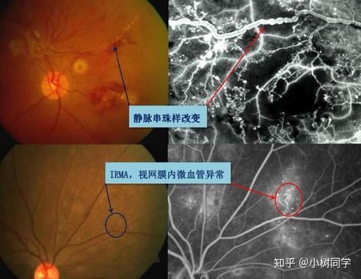 视网膜血管改变