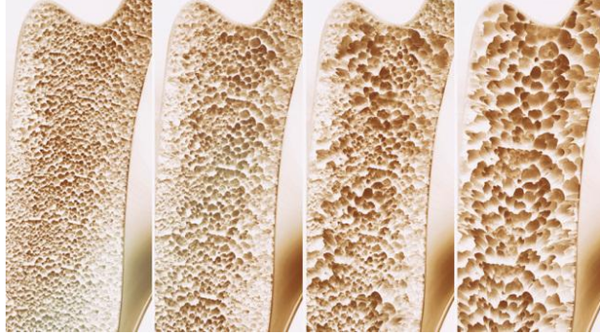 正常骨骼与骨质疏松的骨骼对比图