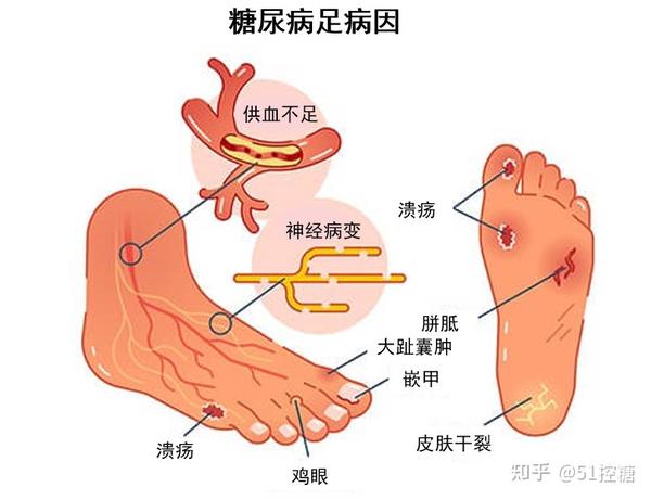 糖友如何预防糖尿病足