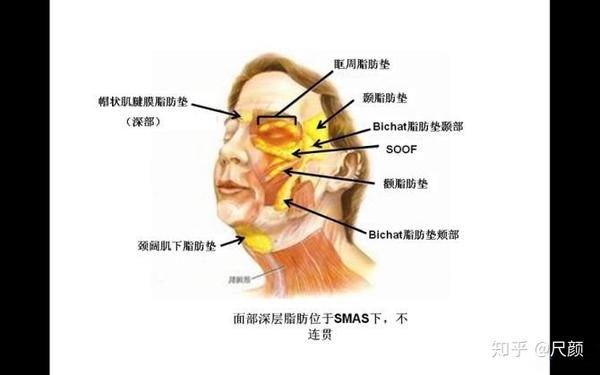 a:帽状筋膜脂肪垫下垂 b:眶周脂肪垫下垂 c:soof脂肪垫下垂 soof脂肪