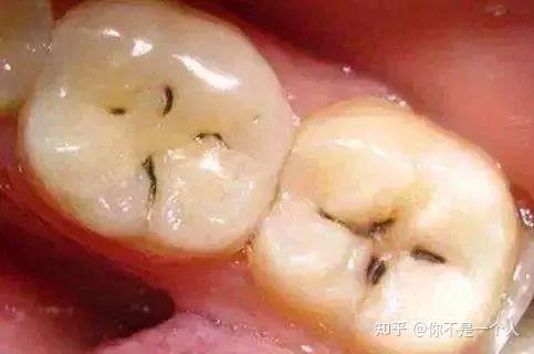 牙齿上出现这种黑点,千万不要作势不管哦!