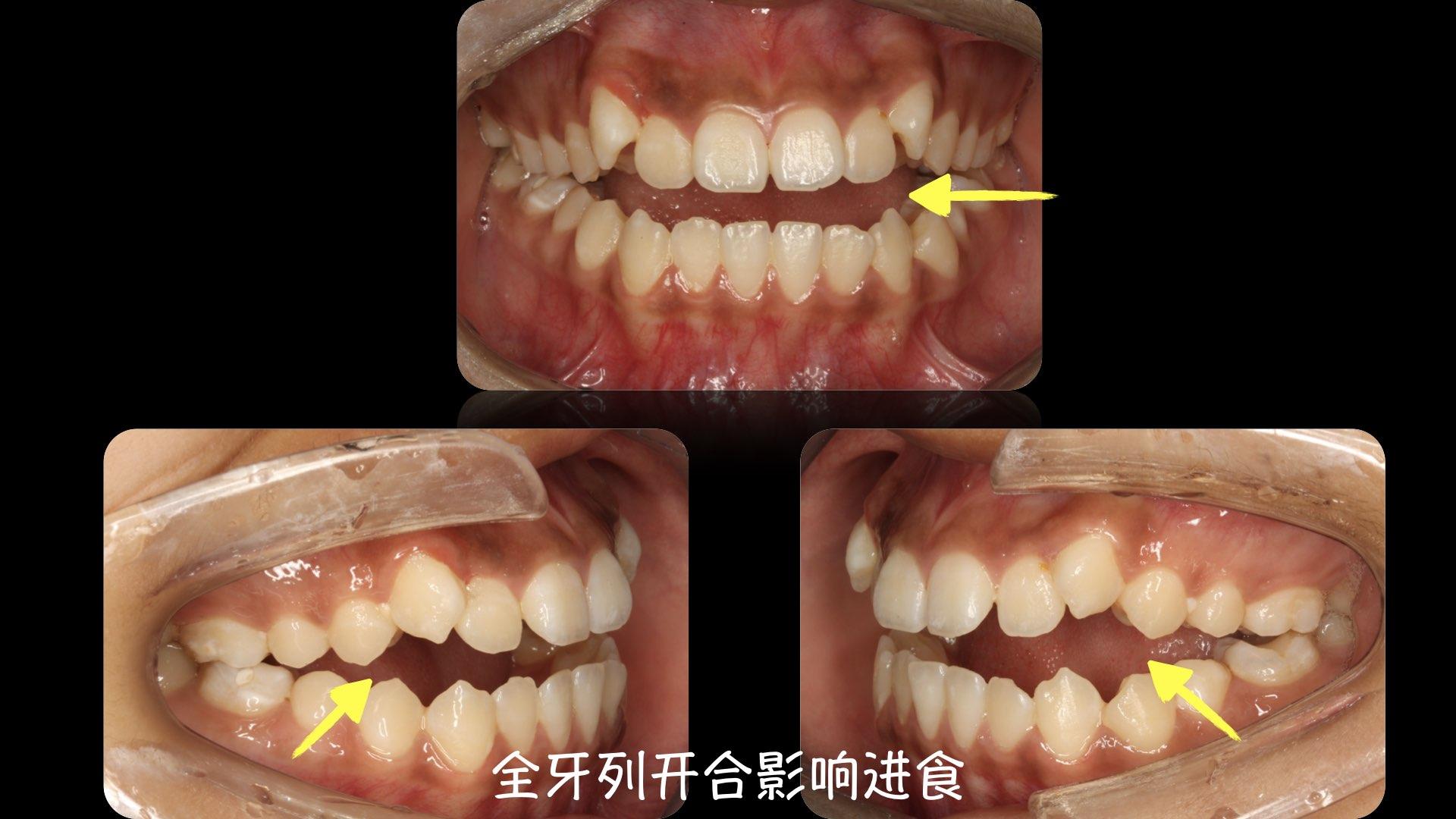 开合是指上下牙齿之间存在较大的间隙,无法正常咬合与咀嚼.