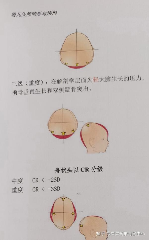 关于宝宝头型的说明