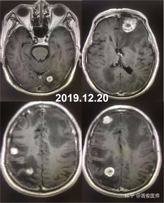 治疗前脑增强核磁共振,多发脑转移瘤,瘤周水肿明显