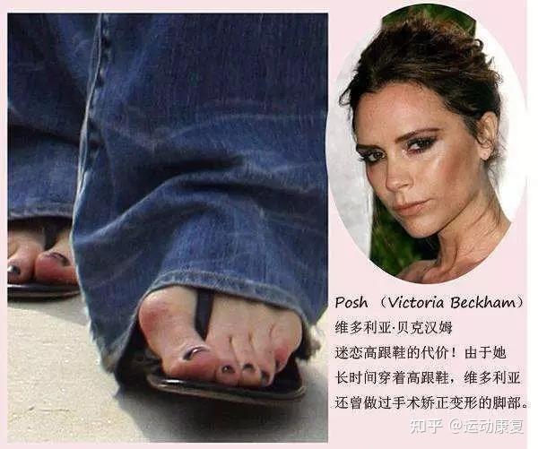 拇外翻经常脚疼的人该注意了