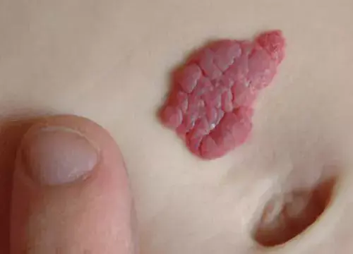 血管瘤的症状有哪些