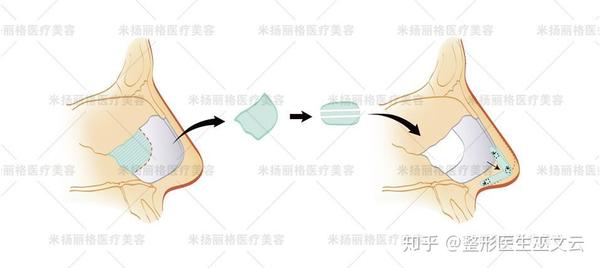 而块状肋软骨需切成片状后搭建支架,面积受限)