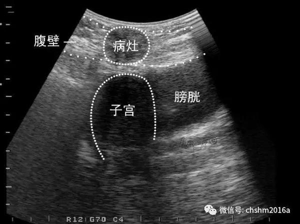 子宫内膜异位超声诊断