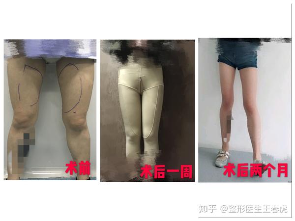 大腿外侧及膝关节周围亦有较多脂肪堆积,还有一部分求美者大腿后外侧