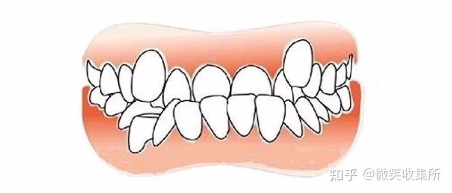 这样真的不好看啊张嘴看到牙齿内扣歪斜影响到牙齿美观度可不是一点半
