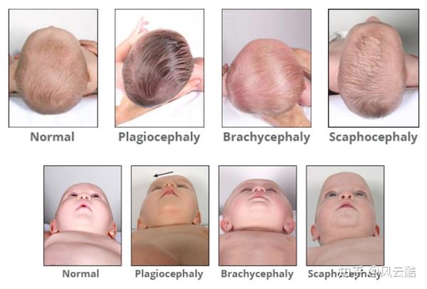 从头顶观察,会看到宝宝后脑勺左右是不对称的.