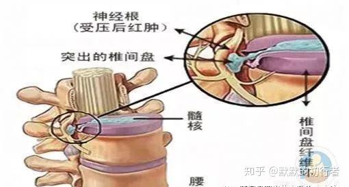 腰椎间盘突出4大感受7大症状,快来对号入座!