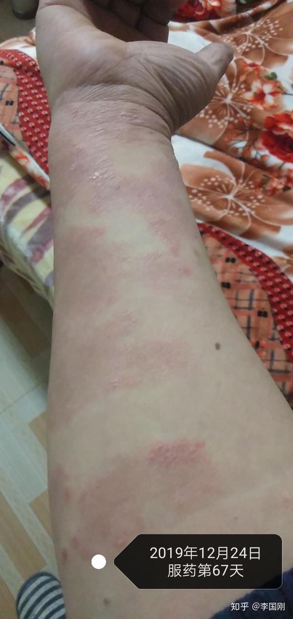 手臂块状银屑病消退顺序图片(山东.滨州)