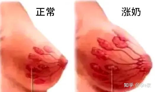 有的妈妈乳房分泌了乳汁,但 乳汁堵在乳腺管里流不出来,乳房像石头一