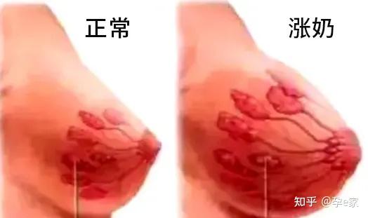 这时候,乳汁,水肿,多余的血液都流向乳房,就会导致生理性涨奶.